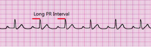 Rhythm Recognition - ACLS Medical Training