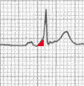 True or False - Question 2 - ACLS Medical Training