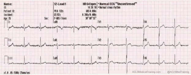 Types of ECG Artifacts | Understanding Interference