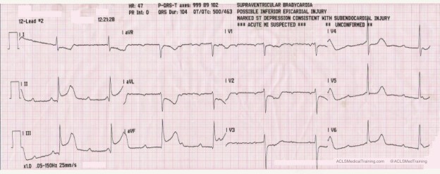 Syncope with Acute Inferior STEMI and 3 Different AV Blocks - ACLS ...