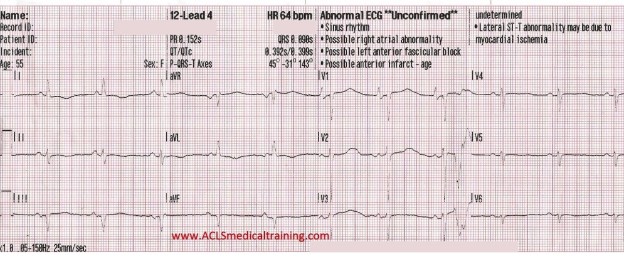 Wide Complex Tachycardia Treated With Amiodarone and Synchronized ...