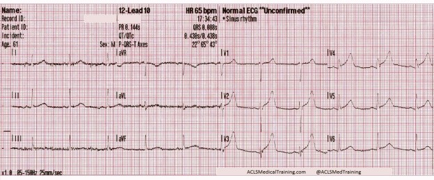 Chest Pain and Transient ST-Segment Elevation - ACLS Medical Training