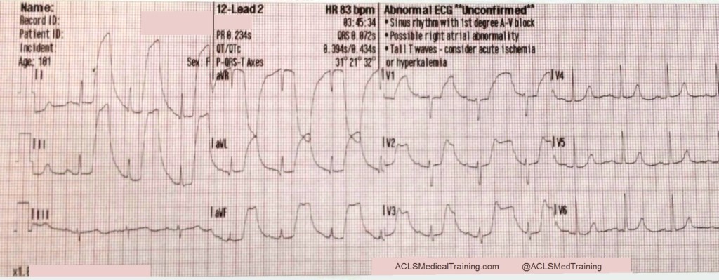 Types of ECG Artifacts | Understanding Interference