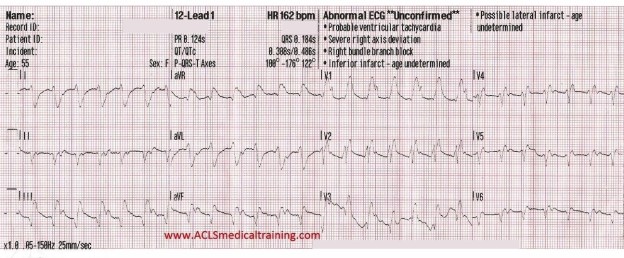 Wide Complex Tachycardia Treated With Amiodarone and Synchronized ...