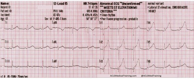 Chest Pain and Transient ST-Segment Elevation - ACLS Medical Training