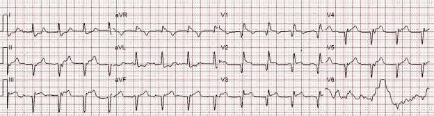 Shock, ST-Segment Elevation, and Massive Pulmonary Embolism - ACLS ...