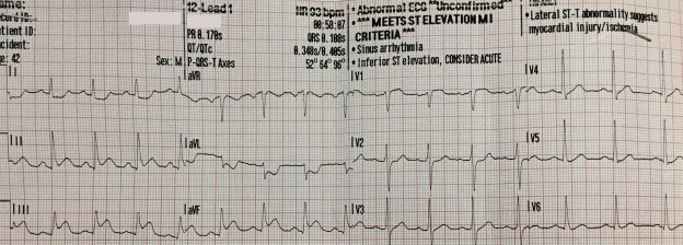 Acute Inferior Stemi With Right Ventricular Infarction And Cardiac