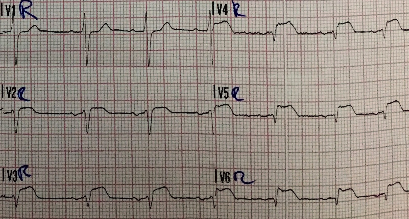 Acute Inferior STEMI With Right Ventricular Infarction And Cardiac 