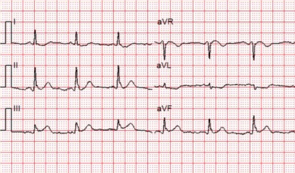 Cardiac Cath Lab Activation for Subtle Acute Inferior STEMI - ACLS ...