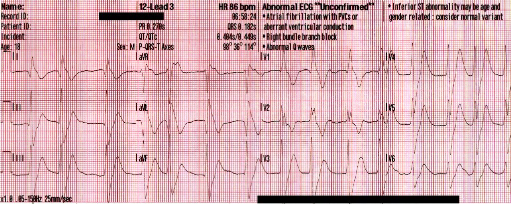 Mixed Overdose and Na-Channel Blockade - ACLS Medical Training