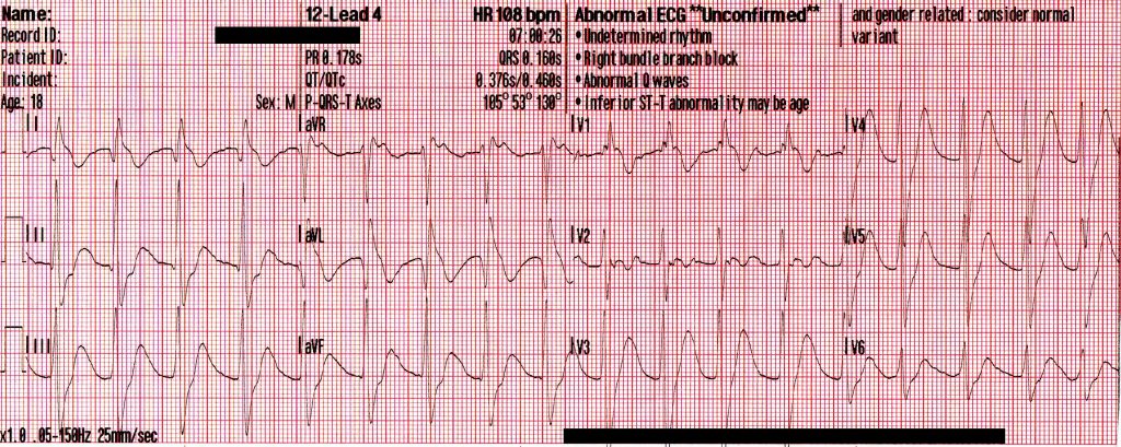 Mixed Overdose and Na-Channel Blockade - ACLS Medical Training