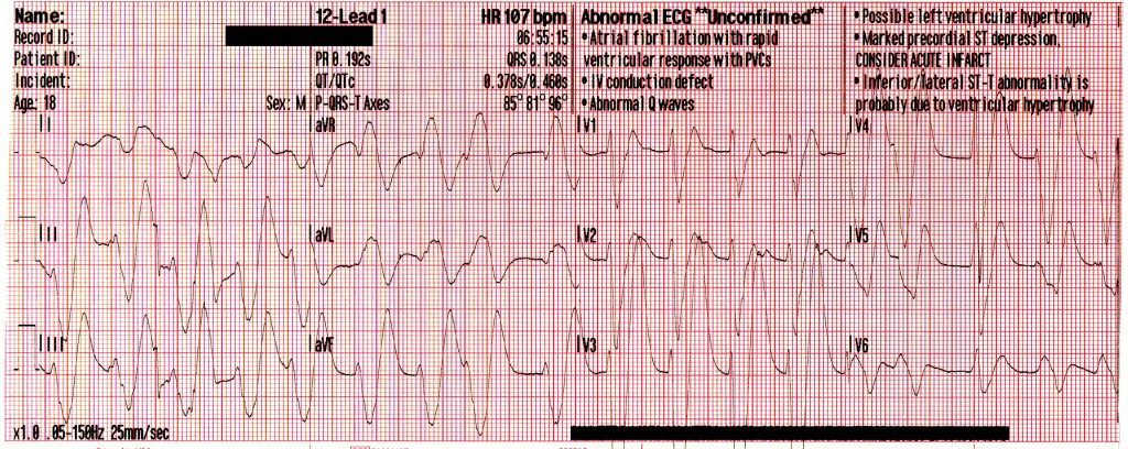 Mixed Overdose and Na-Channel Blockade - ACLS Medical Training