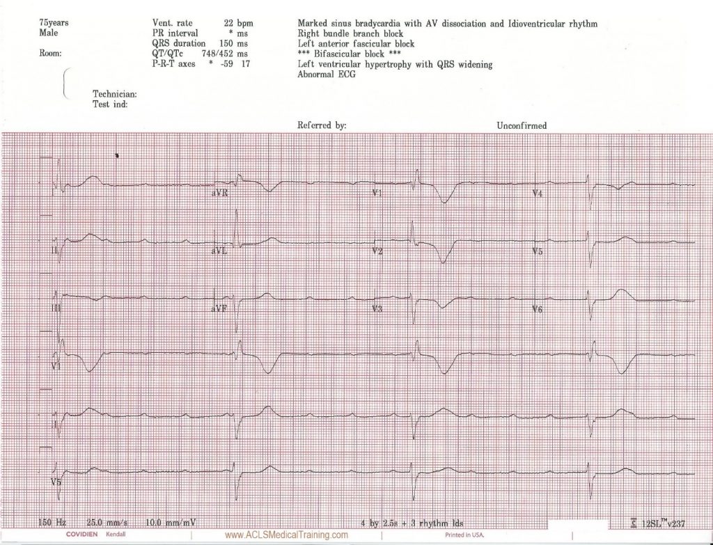 Unstable Bradycardia Resolves Following Atropine and Attempted ...