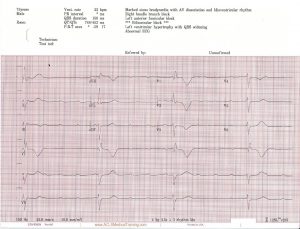 Unstable Bradycardia Resolves Following Atropine And Attempted 