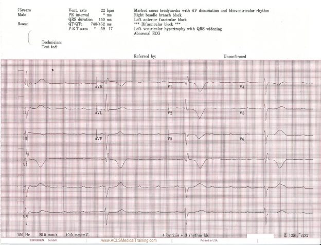 Unstable Bradycardia Resolves Following Atropine and Attempted ...