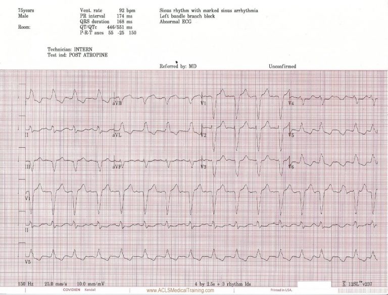 Unstable Bradycardia Resolves Following Atropine and Attempted ...