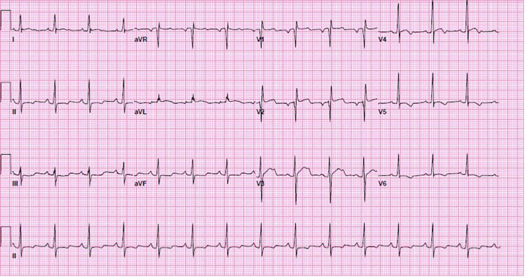 Cocaine Overdose Presents with Wide Complex Tachycardia - ACLS Medical ...