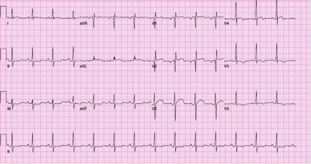 Cocaine Overdose Presents with Wide Complex Tachycardia - ACLS Medical ...