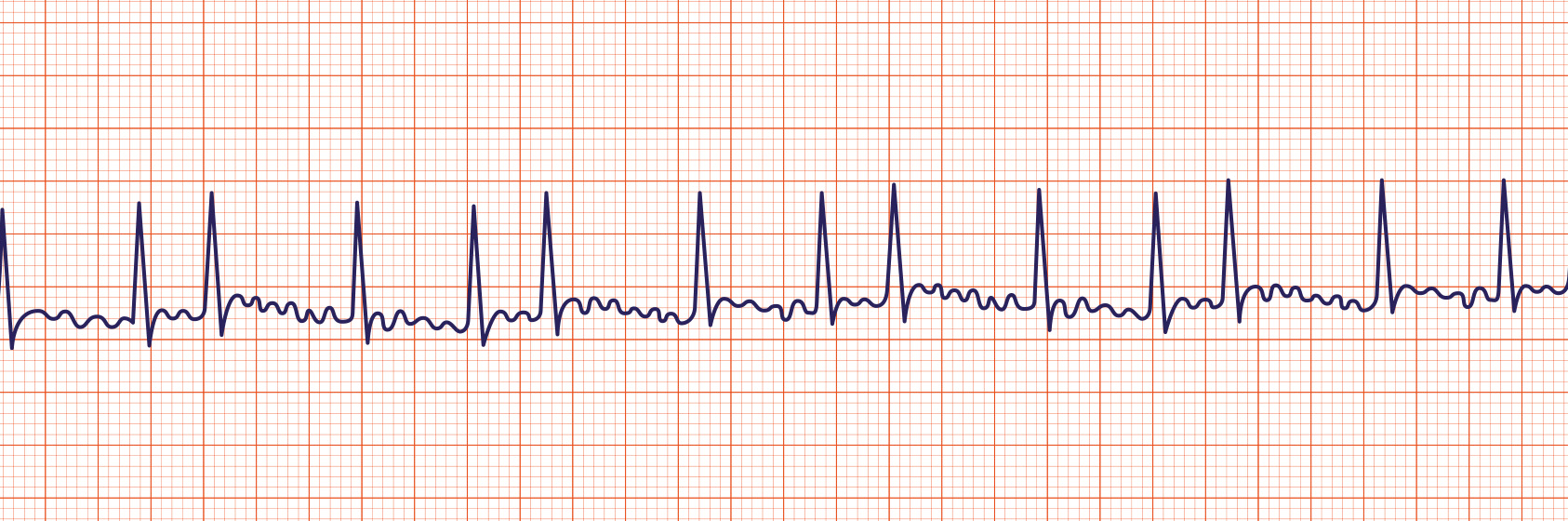 Renewal Question 3 - ECG