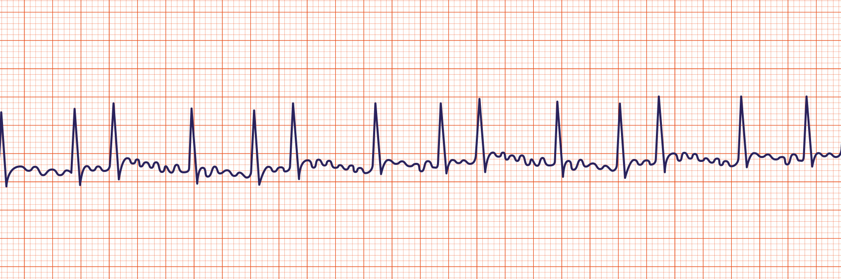 icd 10 atrial flutter