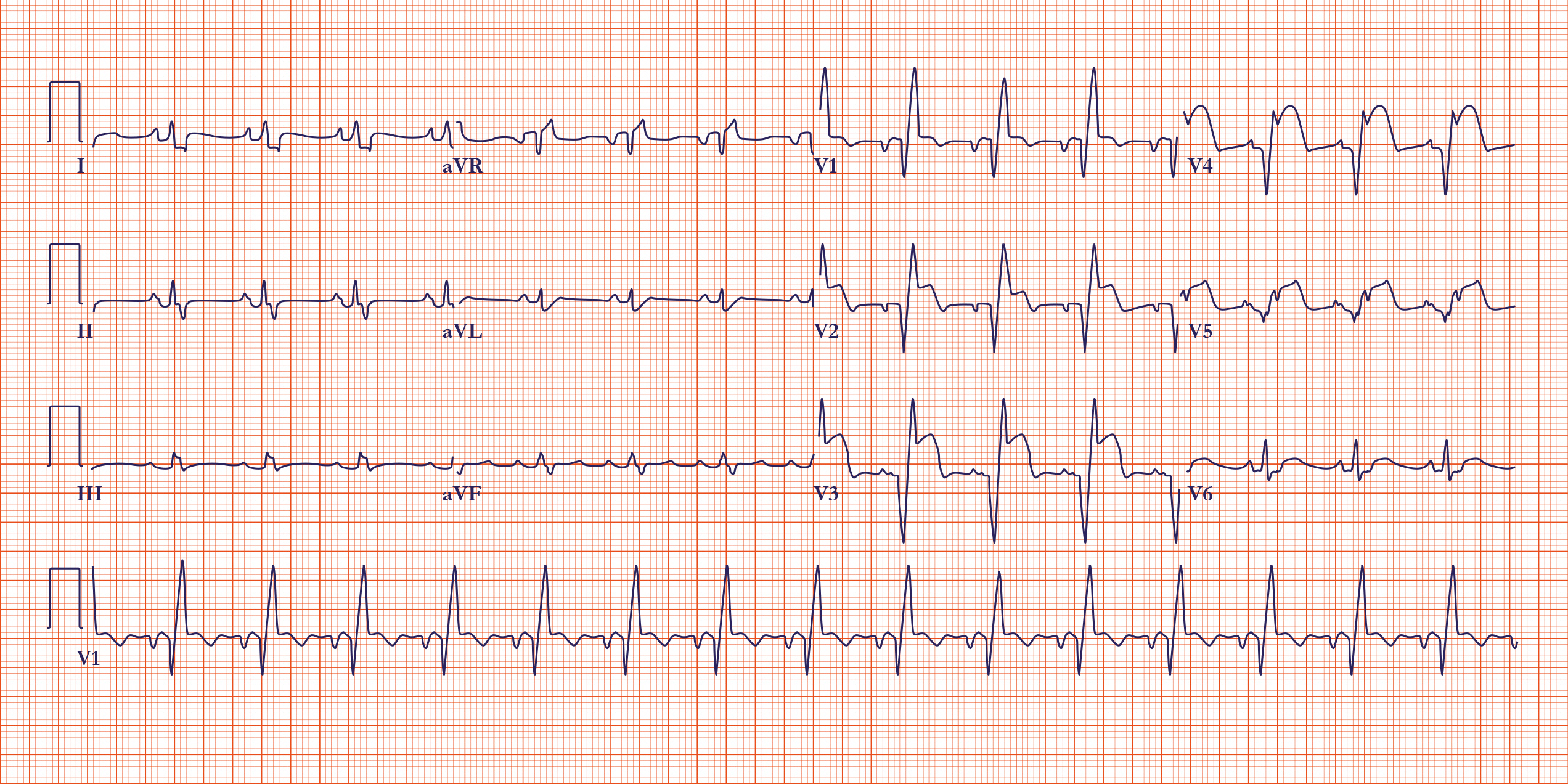 ECGs In Acute Myocardial Infarction ACLS Medical Training